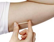 Elle perd l’usage de sa main après le retrait de son implant contraceptif