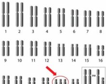 Trisomie 21 : des chercheurs suppriment le « 3e chromosome » in vitro